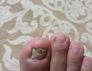 Toenail Issue
