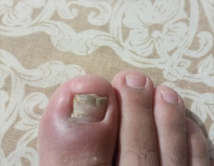 Toenail Issue