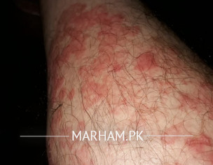 Skin Problem