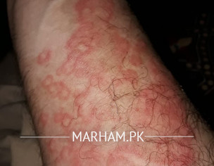 Skin Problem