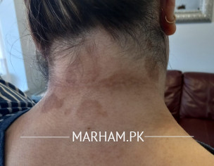 Brown Marks On Skin