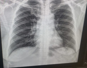 Chest Pain Covid
