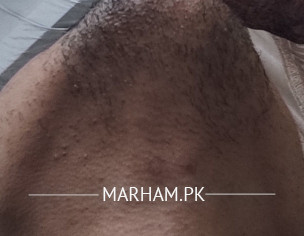Patchy Beard Issue