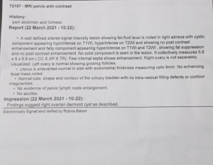 Ovarian Dermoid Cyst