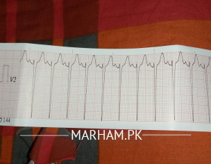 Ecg And Throid Problem