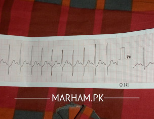Ecg And Throid Problem