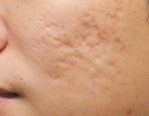 Acne Scars(holes)