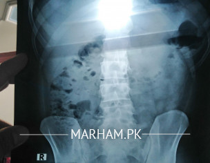 Abdominal X Ray