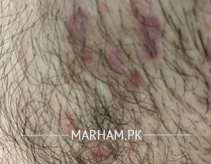 Dermatologist (skin Allergy) Red Itchy Spots 