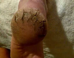Cracked Feets