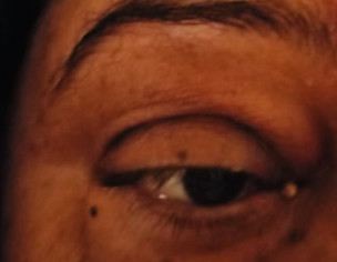 Eye Problem