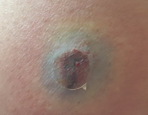 Suspected Insect Bite