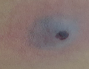 Suspected Insect Bite