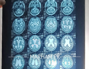 Walking On Baby Steps, Hands Shivering, Loosing Memory