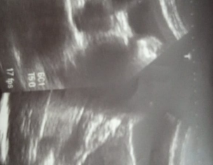 Not Pregnancy Cyst