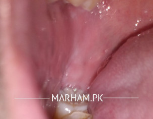 Molar Teeth Problem