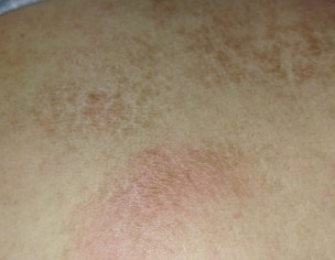 Dry Skin On The Upper Back