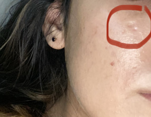 Acne Box Scars