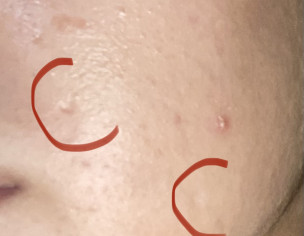 Acne Box Scars