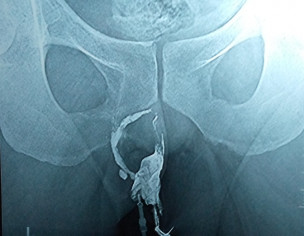 Perianal Sinus