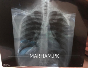 Heavy Chest, Phulghum , Cough And Bretahing Issue