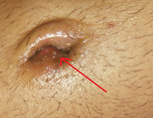 Acne In Belly Button
