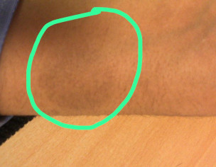 Fix Drug Eruption Patches