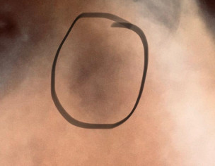 Fix Drug Eruption Patches