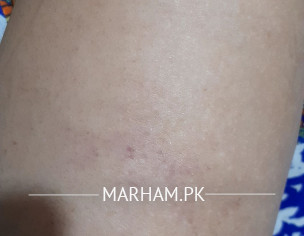 Covid Vaccination AstraZeneca