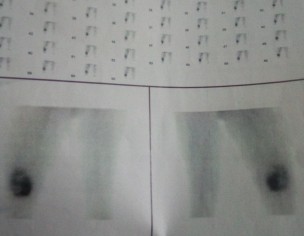 OSTEOGENIC SARCOMA