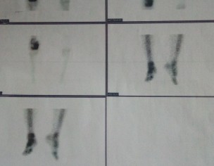 OSTEOGENIC SARCOMA
