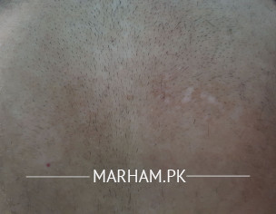 White Spots