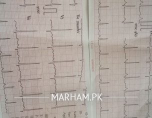 ECG Check