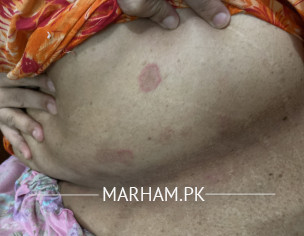 Rash Between Skin Folds