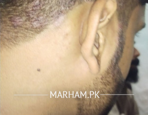 Ask For Dermatologist? Permanent Solution Of Dandruff