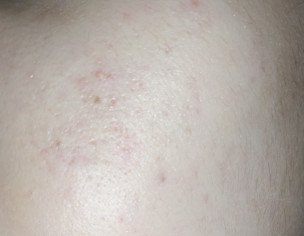 Red Acne Marks