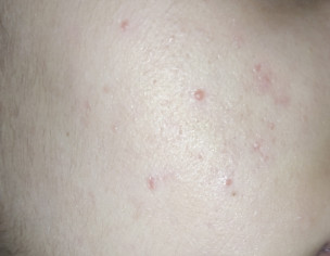 Red Acne Marks