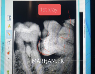 Tooth Xray
