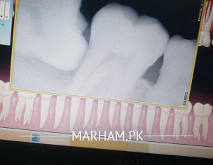 Tooth Xray