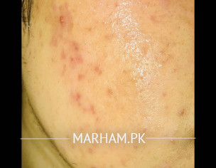 Face  Rashes And Itching.