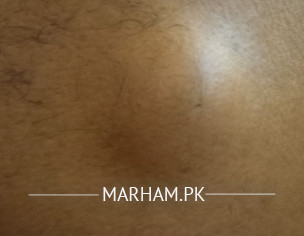 Skin Problem On Back Side