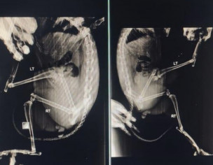 Broken Or Displaced Bone