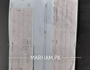 ECG