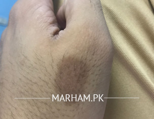 Burn Scar - Dermatologist 