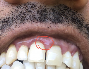 Gum Bleeding And Swelling Problem