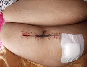 Surgery Wound