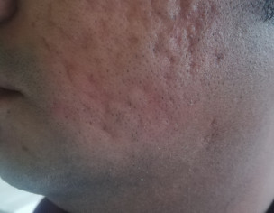 Acne Scars