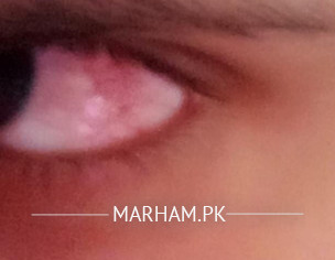 Eye Redness And Pain