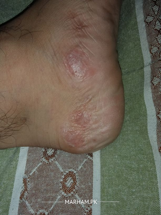 Ask a General Physician Online for Small Water Blisters On Side Of Left ...