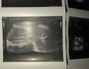 Periods Flow Reduction